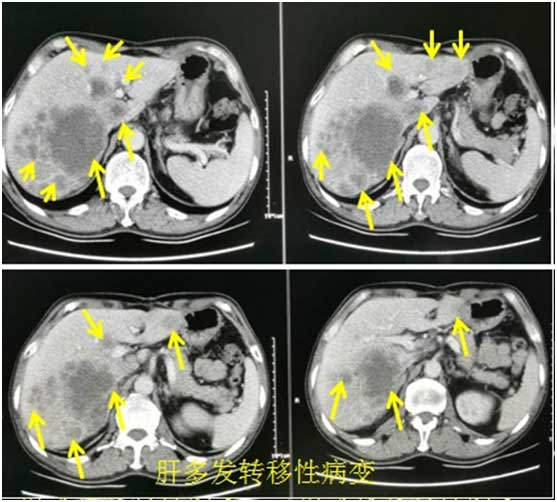 肝脏多发占位临床怀疑贲门癌肝转移petct揭秘真相