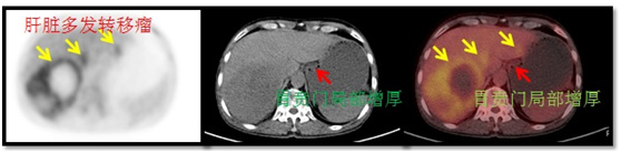 肝脏多发占位临床怀疑贲门癌肝转移petct揭秘真相